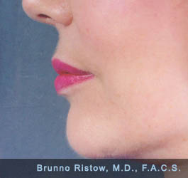 After Plastic Surgery Facelift Lip Volume Restoration