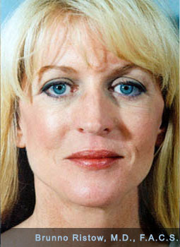 After Plastic Surgery, Face, Neck, Lower Eyelid Lifts and Lip Volume Restorations
(with own live tissues) were performed in San Francisco, CA
