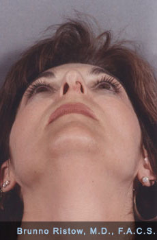 Before Photo of Plastic Surgery
