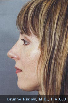 After Postoperative Nose Cosmetic Surgery