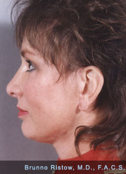 After Cosmetic Facial Reconstructive Surgery