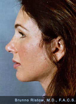 After Plastic Surgery Defined Jaw Neckline and Lip Volume