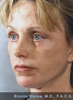 After Surgery image with elevation of low eyebrows, eyelid operations and restoration of the natural
		fullness of young lips