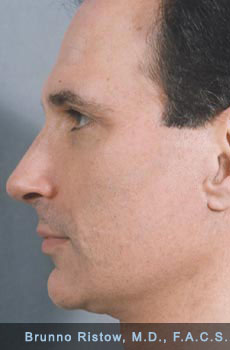 After Male Aesthetic Plastic Surgery, Face, Neck, Rhinoplasty, Eyelid Lift
