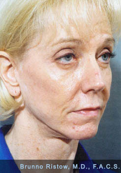 Before Plastic Surgery Performed on Woman in San Francisco, CA