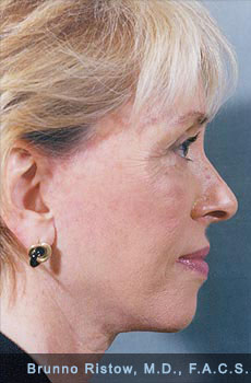 After Face, Neck & Eyelids Cosmetic Surgery