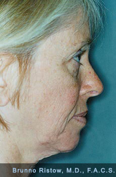 Before Face, Neck & Eyelids Rejuvenation