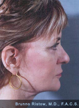 After image of woman surgical Facelift, Upper and Lower Eyelids and a Lip volume enhancement using own
			live collagen.