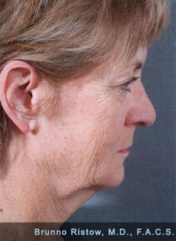 Before Face Lift, Plastic Surgery Image of Woman 