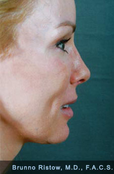After Cosmetic Facial Reconstructive Surgery