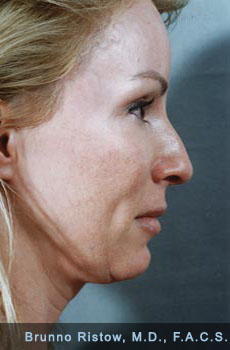 Before Cosmetic Facial Surgery