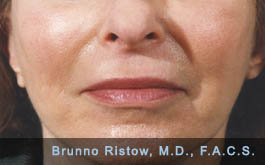 After Facelift, Close up of Lip Volume Restoration