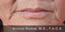 Before Photo of Face and Neck Lift Plus Lip Volume Restorations