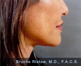 After Photo of Face and Neck Lift Plus Lip Volume Restorations