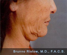 Before Photo of Face and Neck Lift Plus Lip Volume Restorations