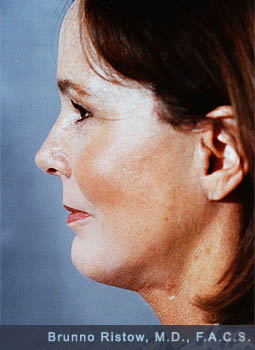 After photo  Facial Neck, Forehead and Eyelids Rejuvenation Plastic Surgery
