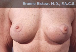 After Breast Surgery
