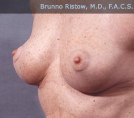 After Breast Surgery