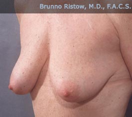Before Breast Surgery
