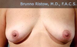 Before Breast Lifts Surgery